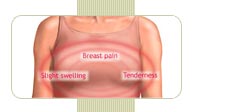 Explanation of breast tenderness