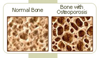 bone with osteoporosis