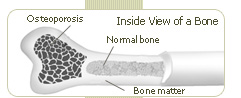 sedentary lifestyle increase risk for developing osteoporosis