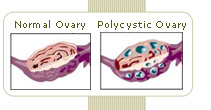 oligomenorrhea can be a symptom of polycystic ovary syndrome
