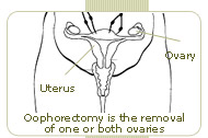 patients who had ovary removal reported cognitive deterioration